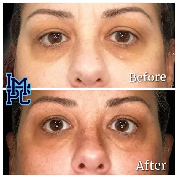 Middle Face Filler treatment 42