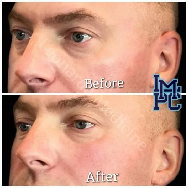 Middle Face Filler treatment 5