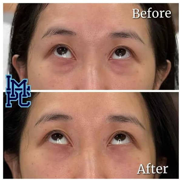 Middle Face Filler treatment 6
