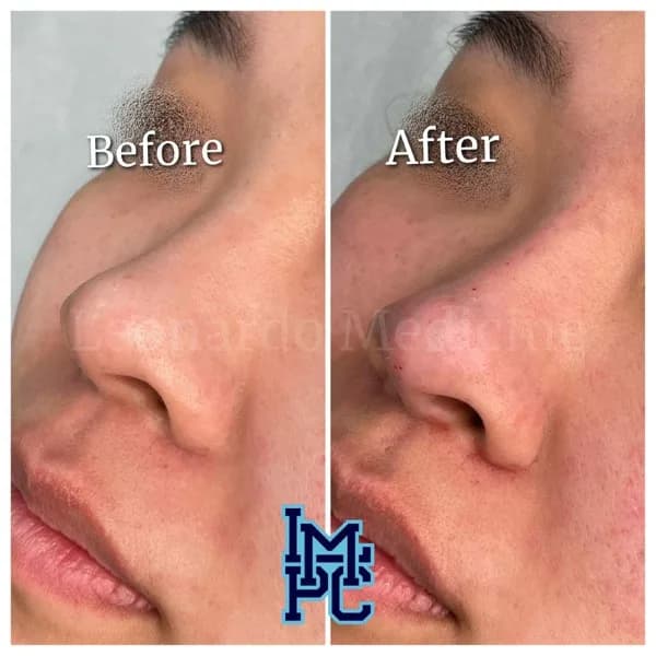 Middle Face Filler treatment 7