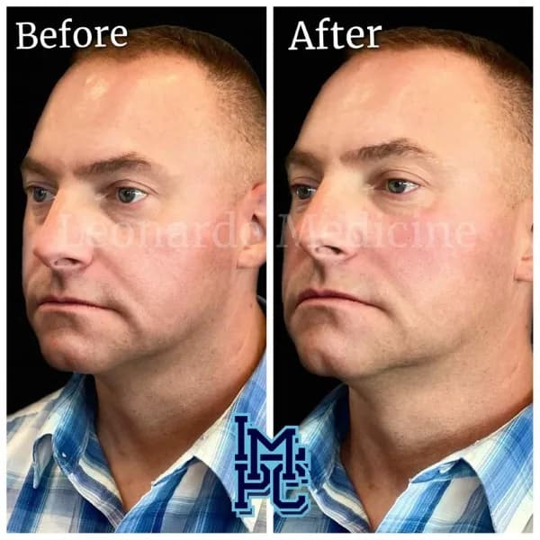 Middle Face Filler treatment 9