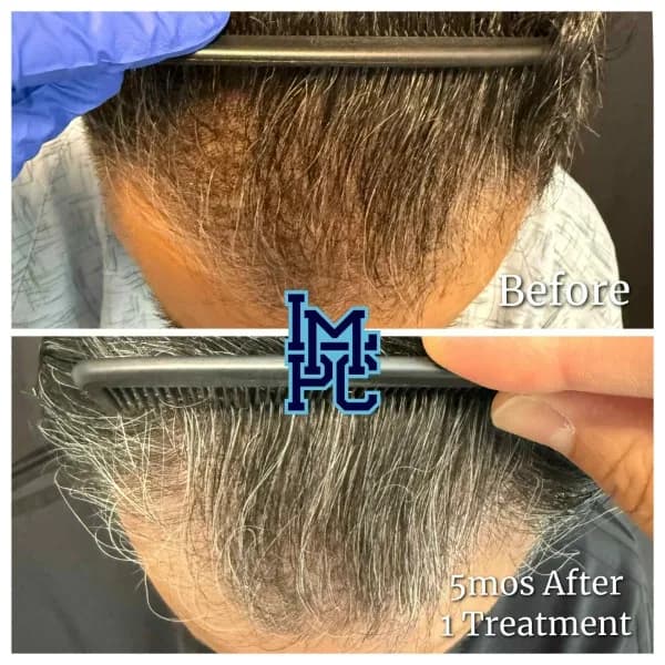 Needleless Hair treatment case 1