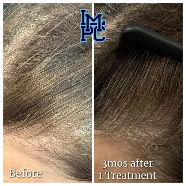 Needleless Hair treatment case 13