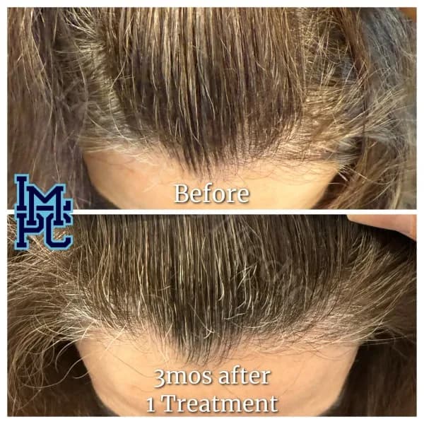 Needleless Hair treatment case 15