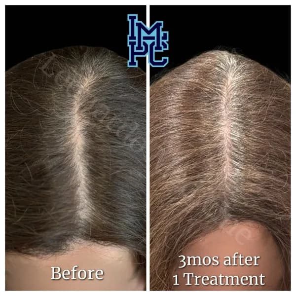Needleless Hair treatment case 16