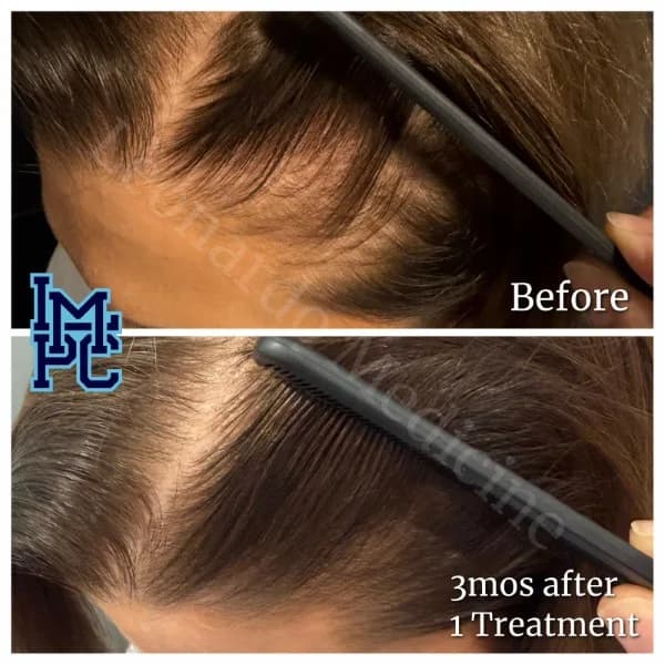 Needleless Hair treatment case 17