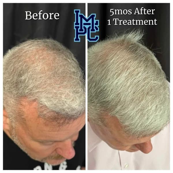 Needleless Hair treatment case 2