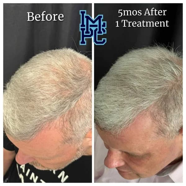 Needleless Hair treatment case 5