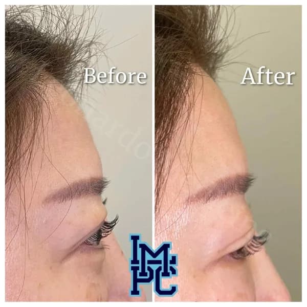 Upper Face Filler treatment 11