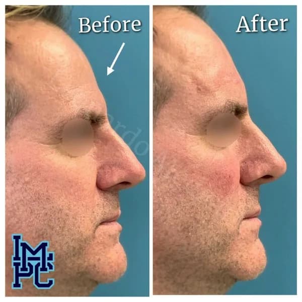 Upper Face Filler treatment 12