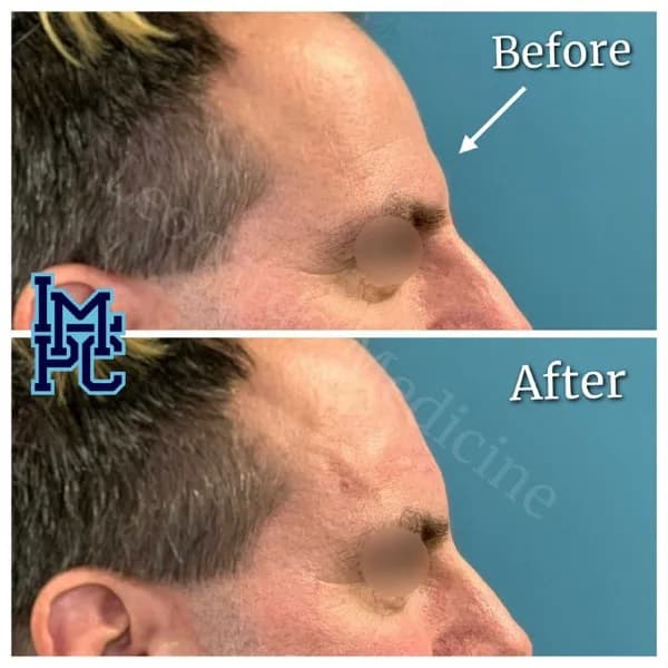 Upper Face Filler treatment 13