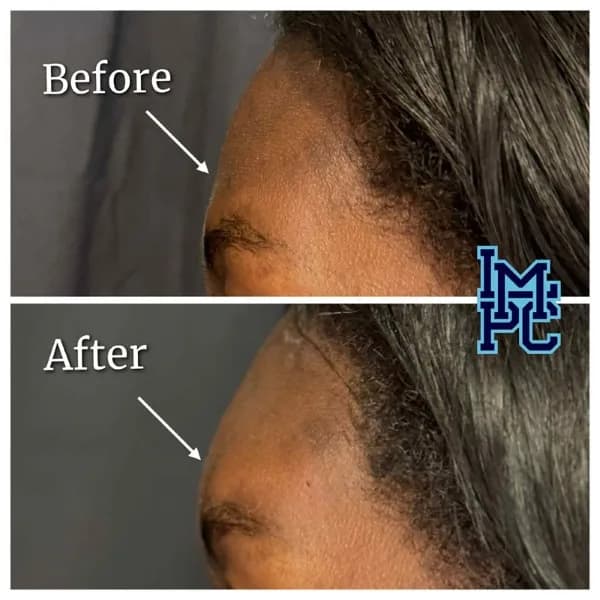 Upper Face Filler treatment 15
