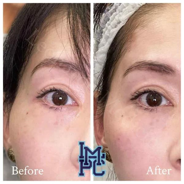 Upper Face Filler treatment 17