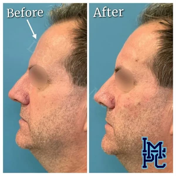 Upper Face Filler treatment 18