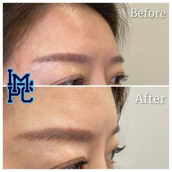 Upper Face Filler treatment 19