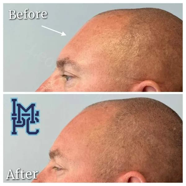 Upper Face Filler treatment 2