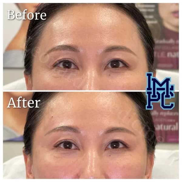 Upper Face Filler treatment 20