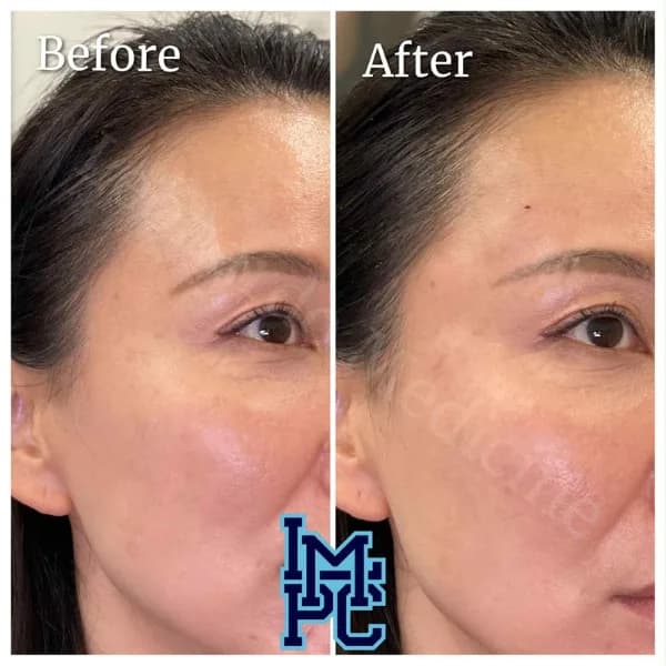 Upper Face Filler treatment 21