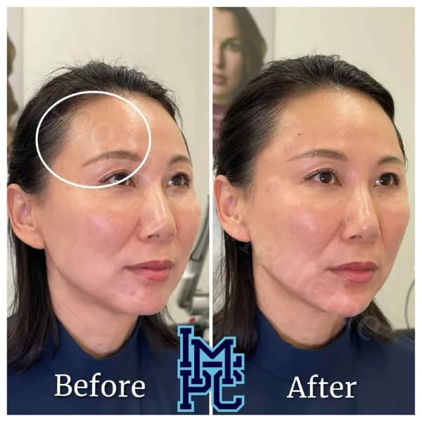 Upper Face Filler treatment 22