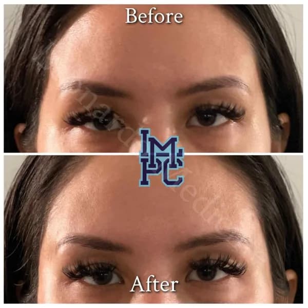 Upper Face Filler treatment 23