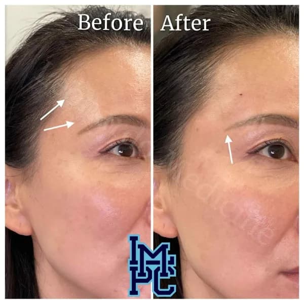 Upper Face Filler treatment 24