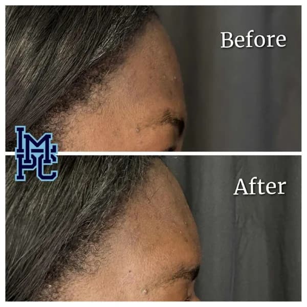 Upper Face Filler treatment 25