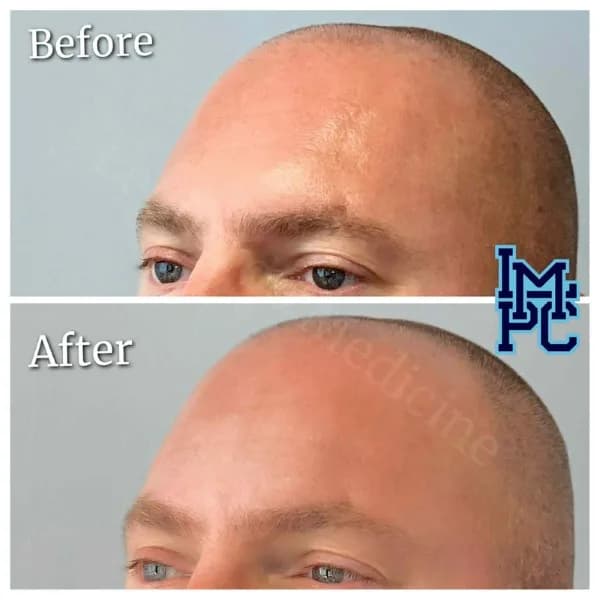 Upper Face Filler treatment 26