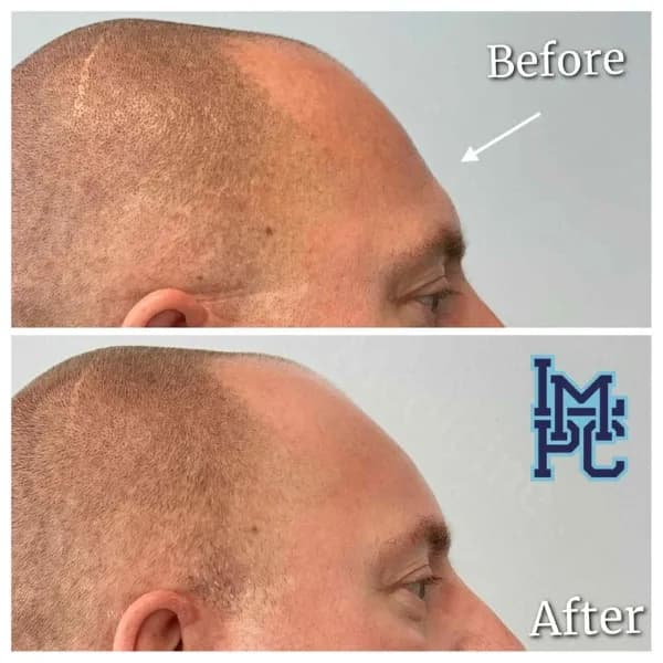 Upper Face Filler treatment 27