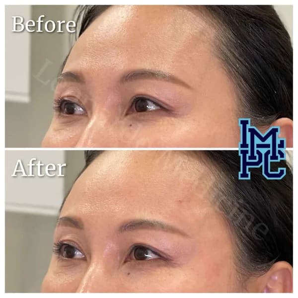 Upper Face Filler treatment 28