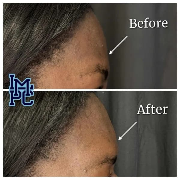 Upper Face Filler treatment 3