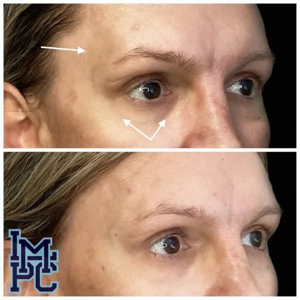 Upper Face Filler treatment 30