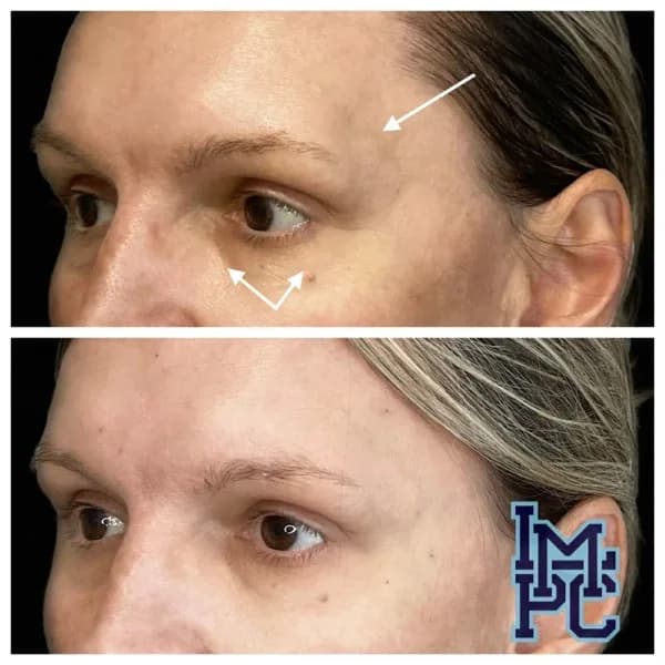 Upper Face Filler treatment 4