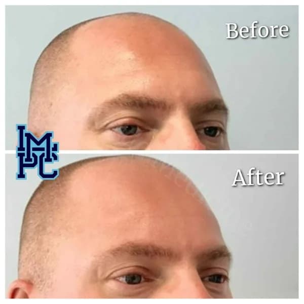 Upper Face Filler treatment 5