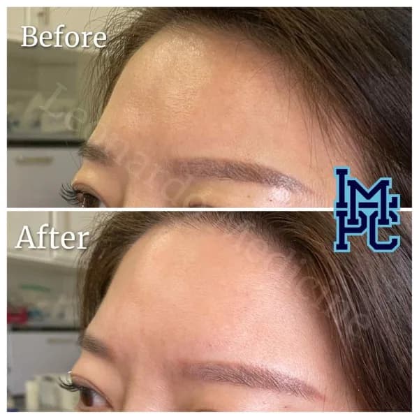 Upper Face Filler treatment 6