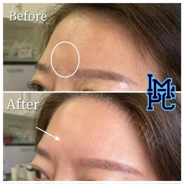 Upper Face Filler treatment 8