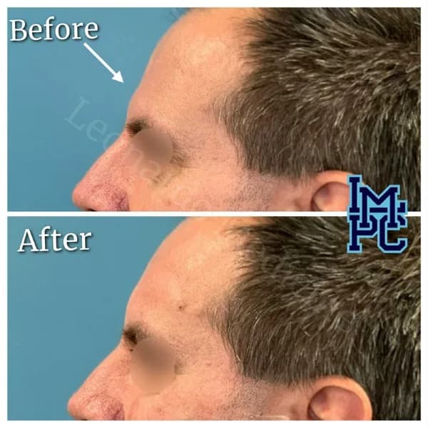 Upper Face Filler treatment 9