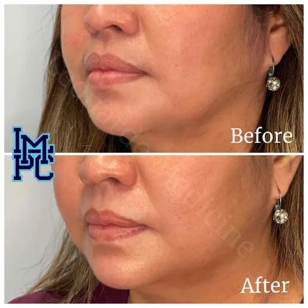 Lower Face Filler treatment 10