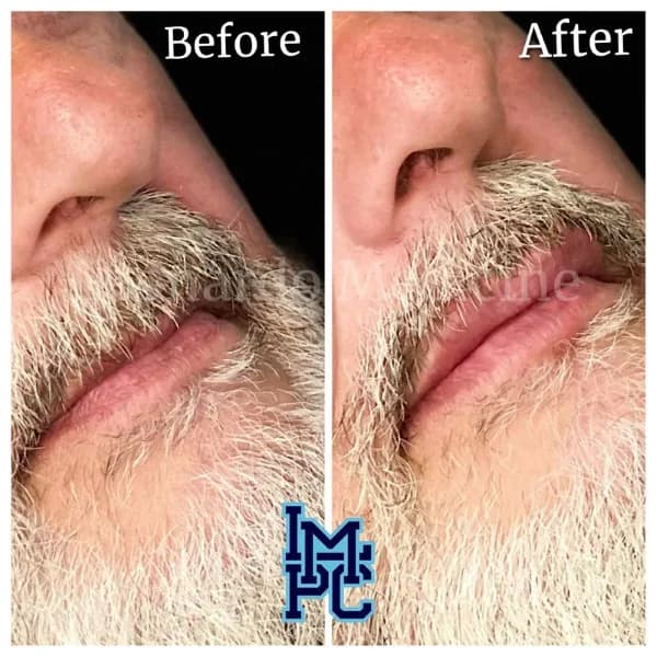 Lower Face Filler treatment 11