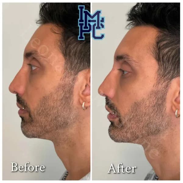 Lower Face Filler treatment 12