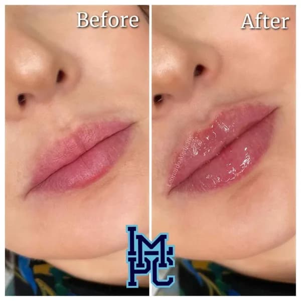 Lower Face Filler treatment 13