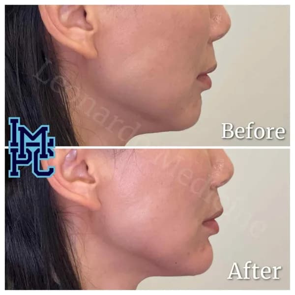 Lower Face Filler treatment 14