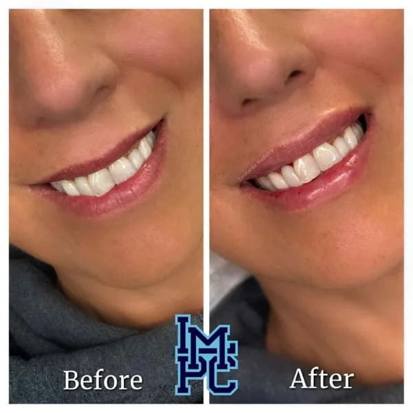 Lower Face Filler treatment 15