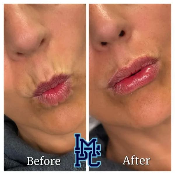 Lower Face Filler treatment 16
