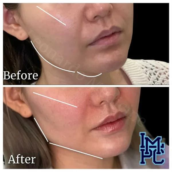 Lower Face Filler treatment 17