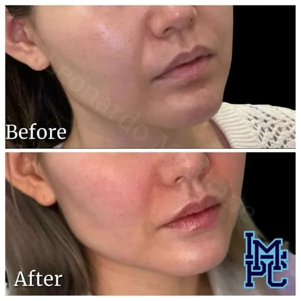 Lower Face Filler treatment 18