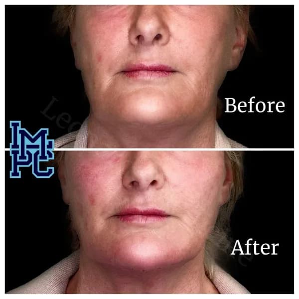 Lower Face Filler treatment 19