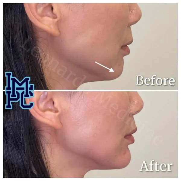 Lower Face Filler treatment 2