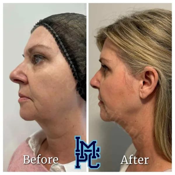 Lower Face Filler treatment 20