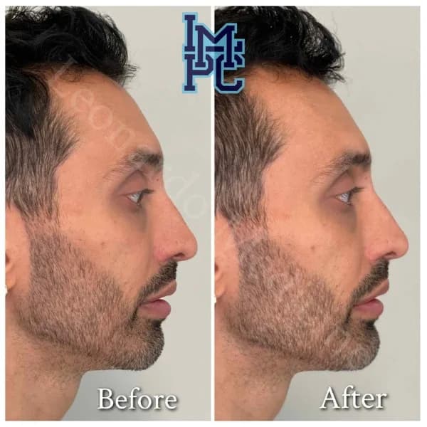 Lower Face Filler treatment 21