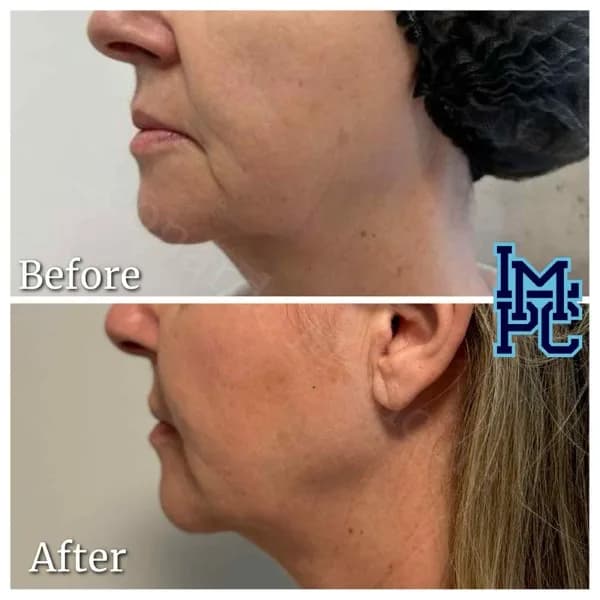 Lower Face Filler treatment 22